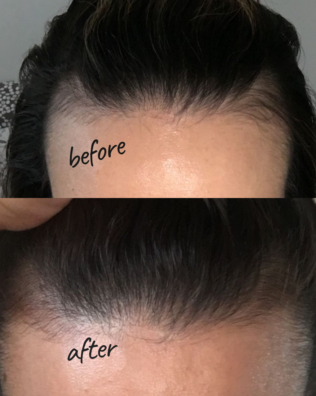 PRP Hair Restoration — Hair Growth Result NYC